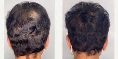 35-44 year old woman treated with Hair Loss Treatment, PRP for Hair Loss, Low-Level Laser Therapy - PRP procedure done for Hair Loss