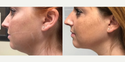 25-34 year old woman treated with Microneedling RF - One Agnes RF Treatment, 1 month post-op