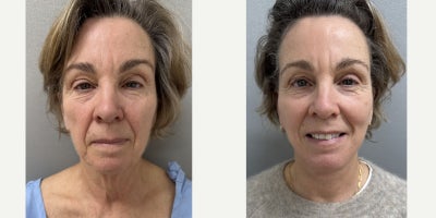 65-74 year old woman treated with Facelift - 67 y/o, 1 month after a NaturalLyft facelift in our office under sedation.