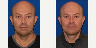 65-74 year old man treated with SMAS Facelift, Neck Lift, Eyelid Surgery - A male patient had a lower face and neck lift surgery (SMAS) in the combination with a lower eyelid lift.