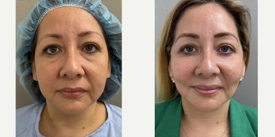 35-44 year old woman treated with Facelift - 43 y/o, 3 months after NaturalLift Facelift, buccal fat removal and lower eyelid fat bag removal under sedation in our office.