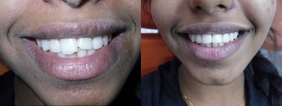 A 17 year old girl treated conservatively and esthetically for fractured front teeth - 
	Composite bonding was done in a very conservative manner.
