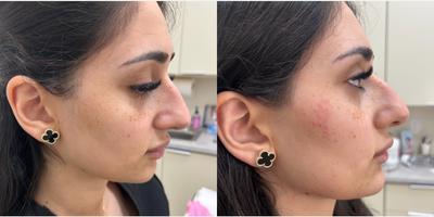 18-24 year old woman treated with Restylane Contour, Restylane Defyne - Facial balancing. Cheek FillerChin FillerJowels