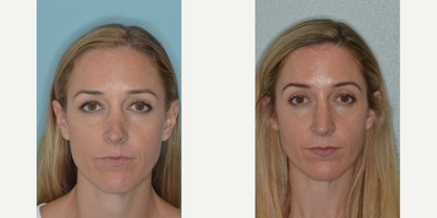 35-44 year old woman treated with Revision Rhinoplasty - Patient who had undergone a previous rhinoplasty and was seeking revision. Revision rhinoplasty techniques employed to help de-project her nose, correct the deformities of the bridge, and soften the pointy appearance to the tip.