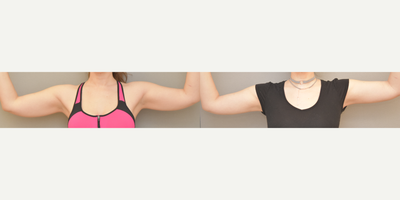 34 year old woman treated with Tumescent Liposuction - Smartlipo arms