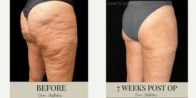 45-54 year old woman treated with Aveli - We have been receiving amazing results with combination therapy using our Aveli Tool & Sylfirm X device to improve the appearance of cellulite dimples and skin laxity. We always want to be transparent with our clients - So today we wanted to talk about the downtime for our newest Cellulite Solution.