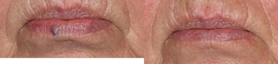 79 year Old Female Treated for Venous Lake on Lower Lip - Venous Lake on lower lip, after 1 Excel 1064 treatment