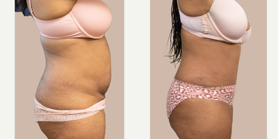 35-44 year old woman treated with Tummy Tuck - This patient underwent a tummy tuck to remove excess skin and tighten the abdominal muscles. She is shown 3-months post-op.