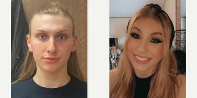 18-24 year old woman treated with Facial Feminization Surgery, Transgender Facial Feminization Surgery, Septoplasty - 18 to 24 year-old female patient is 1 month post-op from Facial Feminization surgery. Her procedures included: Forehead Lift, Hairline Lowering, Orbital Bony Contouring, Septorhinoplasty (closed) with Cartilage Grafts, Radix Graft and Weirs, Cheek Implants (small), Chin Reduction and Contour, Subnasal Lip Lift with Fat Augmentation to Lips, Thyroid Cartilage Shave, and 300 Micrografts to Recessions.