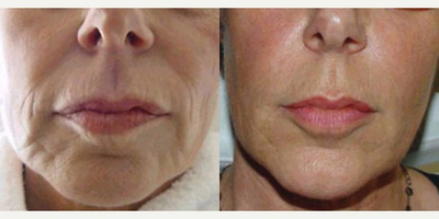 Liquid Facelift - Liquid Facelift
