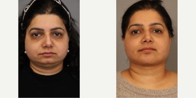 Woman treated with Neck Lift - Woman treated with Neck Lift, Chin Implant, and Cheek Liposuction to address fullness of her face.