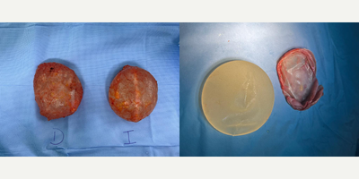 35-44 year old woman treated with Enbloc Breast Implant Removal, Capsular Contracture Treatment - Female patient with breast illnes implant syndrome and moderate capsule contracture  and implant malposition. She had a breast augmentation with textured round silicon gel implants 6 years ago. Dr. Valdez performed an implant removal  surgery with Enbloc technique.