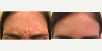 25-34 year old woman treated with Botox - Young female desiring treatment of her strong scowling lines. Treated with 20 units of Botox in the glabellar region.