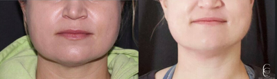 Woman treated with Cryoskin - Woman treated with Cryoskin