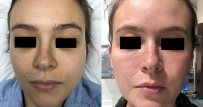 25-34 year old woman treated with Vampire Facial - 25-34 year old woman treated with Vampire Facial