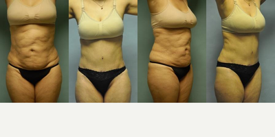 42 year old woman treated with Liposuction Revision and Abdominoplasty - 42 year-old woman who had liposuction deformities of her abdomen, waist and flanks. She had an extremely irregular surface with over-resection of fat in places. The extent of the problem precluded successful treatment with revision liposuction alone. She is shown almost two years after vaser ultrasonic liposuction revision of her abdomen, waist and flanks. A tummy tuck was done to smooth out her abdomen and remove the damaged lower abdominal skin.