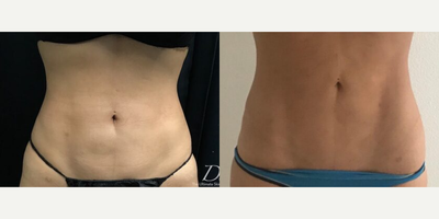 Woman treated with CoolTone - Woman treated with CoolTone