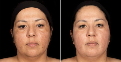 Woman in her 30's treated with Laser Treatment (Fractora RF) - Woman in her 30's treated with Laser Treatment (Fractora RF), 2 weeks post-op