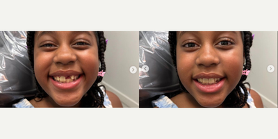 Girl treated with Tooth Repair - Pure joy, cosmetic dentistry ,cosmetic dentist, new smile, smile transformation