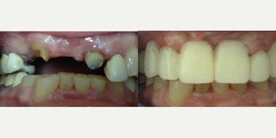Patient  treated with Dental Bridge - This patient didnt have much to work with. He wanted to do whatever was possible and fitting to his budget to improve his smile. Thankfully, here at the Goldstein Dental Center, nothing is impossible. Dr. Wait was able to give this patient his smile back by fabricating a dental bridge onto the top front teeth. A dental bridge is an affordable, permanent solution, for patients without many teeth left to work with.