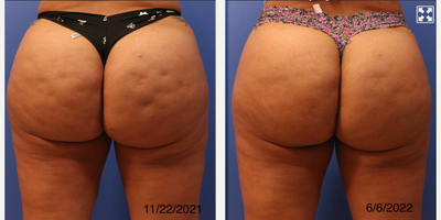 35-44 year old woman treated with Cellfina - Cellfina treatment on buttocks