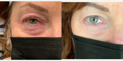 65-74 year old woman upper and lower eyes treated with Plasma Pen - Subnovii plasma pen treatment to eyes for upper eyelid hooding and under eye laxity and bags. This is taken 1 month post procedure.
