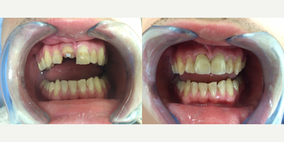 18-24 year old man treated with Tooth Repair - This young man fell years ago and fractured/chipped his two front teeth (#8 & 9) and was restored with dental bonding by another dentist.  #8 required root canal treatment years back and the tooth was mostly filling material which contributed to the current issue of horizontal fracture of 2/3 of the coronal surface of the tooth.  The treatment options were discussed with the patient and he came to the conclusion to fabricate a cast post/core and crown #8 and #9 with all ceramic crowns.   Post op pictures taken immediately after insertion of crowns #8/9