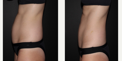 25-34 year old woman treated with UltraShape Power - This is combination treatments with the use of Ultrashape and Velashape