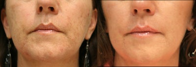 Obagi - 
	Age 55. Obagi Nu-Derm is a complete physician-dispensed, prescription-strength skincare system. That helps correct age spots, fine lines and wrinkles, rough skin, skin laxity, redness, tone and texture and hyperpigmentation . Photos taken 4 months post treatment. Recovery time: No downtime.
