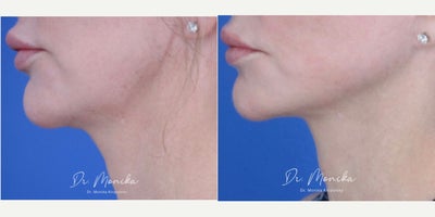 Woman treated with ResurFX and Botox - This women's jawline is sharper and more defined due to ResurFX and Botox.