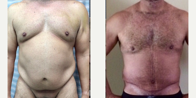 Male Tummy Tuck + Intense Lipo + Breast Reduction (Gynecomastia Correction) - Male Tummy Tuck + Intense Lipo 10L Fat Removed From Tummy, Flanks. Waist, Armpits, Upper/Lower Back