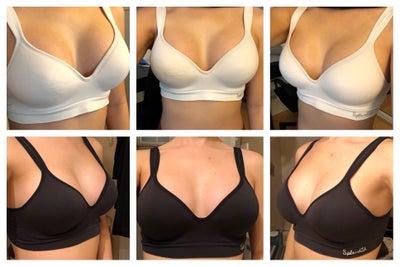 FAQs About “Drop and Fluff” After Breast Augmentation