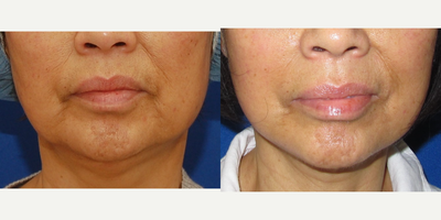 45-54 year old woman treated with MACS Facelift - face lift