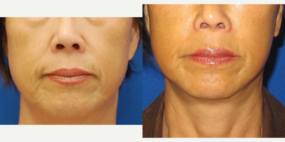 45-54 year old woman treated with MACS Facelift - face lift