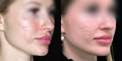 25-34 year old Female underwent Acne treatment - A 25-34 year old Female underwent Acne treatment with Dr. Khorasani. Patient had vascular laser treatment, clear and brilliant and photodynamic therapy.