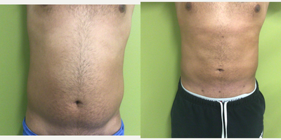 25-34 year old man treated with Tickle Lipo - S/P liposuction of abdomen and flanks