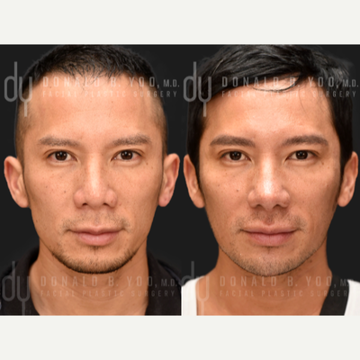 35-44 year old man treated with Asian Rhinoplasty, Alarplasty, Revision Rhinoplasty, Septoplasty, Rhinoplasty, Chin Filler, Rest - Revision Rhinoplasty and alarplasty using his own rib cartilage and DCF (Diced cartilage fascia) to create a more projected and defined nose. Chin filler was done to achieve a greater balance.