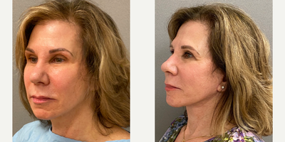 55-64 year old woman treated with Facelift, SMAS Facelift, Neck Lift, Facelift Revision - 62 yo s/p secondary facelift in our on site AAAA certified operating suite under local anesthesia with sedation.