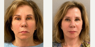 55-64 year old woman treated with Facelift, SMAS Facelift, Neck Lift, Facelift Revision - 62 yo s/p secondary facelift in our on site AAAA certified operating suite under local anesthesia with sedation.