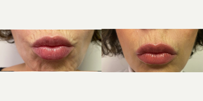 55-64 year old woman treated with Sofwave - One treatment for lip and chin- no injections in between.
