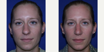 25-34 year old woman treated with Rhinoplasty - 25-34 year old woman treated with Rhinoplasty