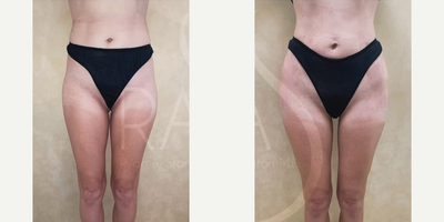 Woman treated with Butt Implants - Woman treated with Butt Implants