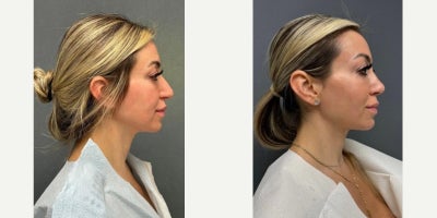 35-44 year old woman treated with Rhinoplasty - Patient is 1 week post-op rhinoplasty.