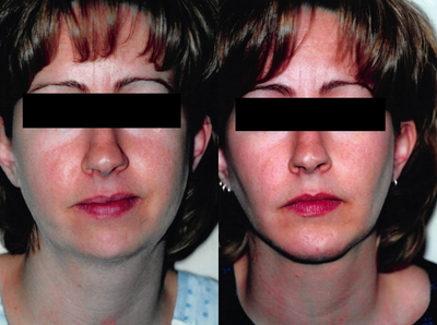 35-44 year old woman treated with Buccal Fat Removal - This patient had buccal fat removal through small incisions inside the mouth. This is done in the office under local anesthesia.
