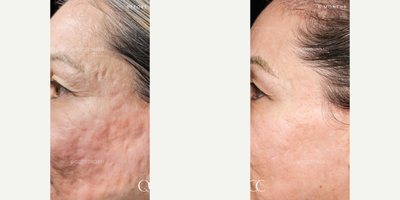 Acne Scars Combination Treatment with Subcision and CO2 Laser by Dr. Qazi - Acne Scars Combination Treatment with Subcision and CO2 Laser