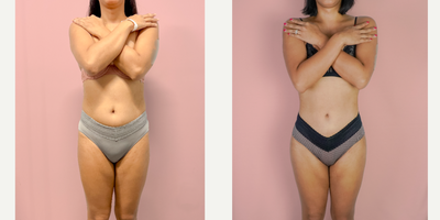 25-34 year old woman treated with Liposuction, Tumescent Liposuction, Vaser Liposuction - This lovely patient requested liposuction to improve her contour, shape and curves. After she explained her goals, we planned to remove fat from unwanted areas and enhance her curves. She is shown 4 months after liposuction.