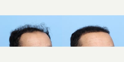 18-24 year old man treated with FUE Hair Transplant, PRP Injections - This 24-year-old patient was unhappy with his receding hairline. Dr. Wise performed an FUE hair transplant and one session of PRP therapy to achieve these results.