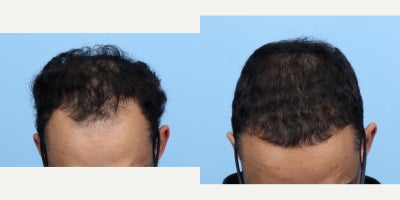 18-24 year old man treated with FUE Hair Transplant, PRP Injections - This 24-year-old patient was unhappy with his receding hairline. Dr. Wise performed an FUE hair transplant and one session of PRP therapy to achieve these results.