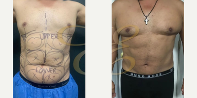 Man treated with Vaser Liposuction - Man treated with Vaser Liposuction