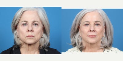 65-74 year old woman treated with Facelift - SMAS FACELIFT WITH PLATYSMALPLASTY AND FACIAL FAT GRAFT